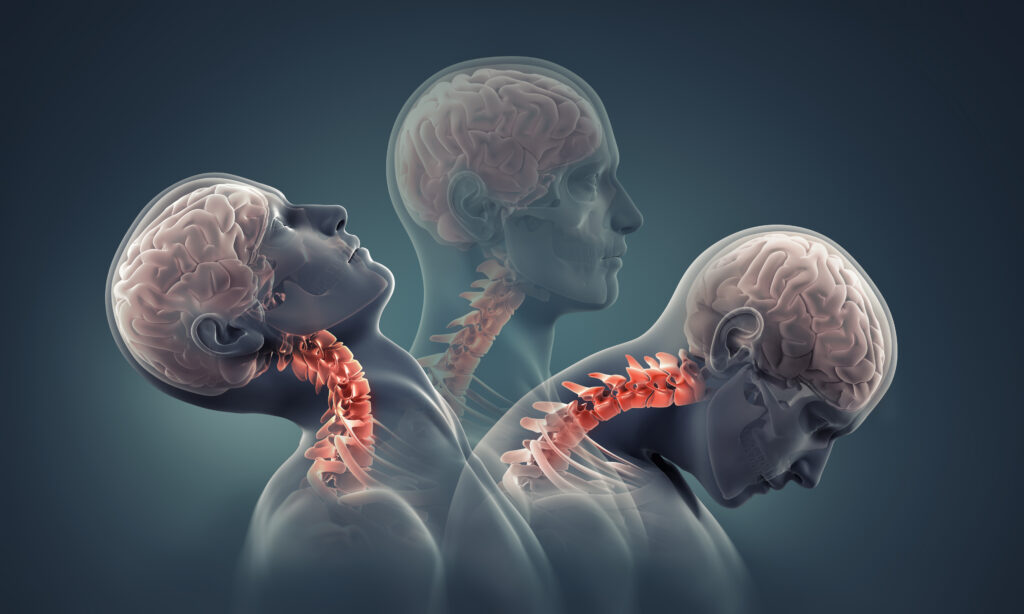 car accidents high risk of causing neck and back injury